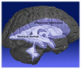 Ventricoli idrocefalo normoteso